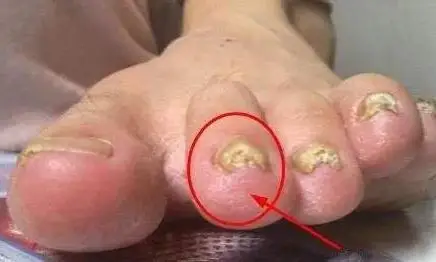 糖尿病烂脚发生前,身体有6个信号,早知道早预防