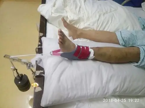 跟骨皮肤牵引,说实话,如果不是你陪我聊天说话,我估计会更加煎熬,是你