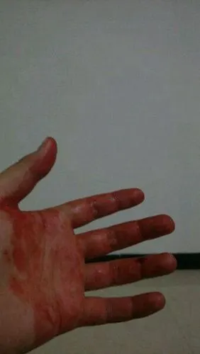 手指流血图片52