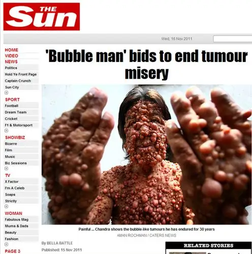 印尼57岁男子钱德拉维斯努(chandra  wisnu)患上了一种罕见的疾病