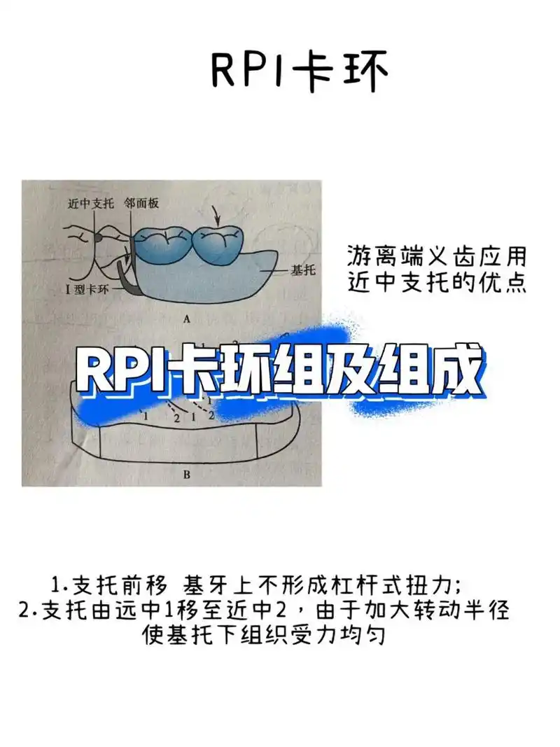 rpi卡环组组成及优缺点 rpi卡环组由近中牙合支托