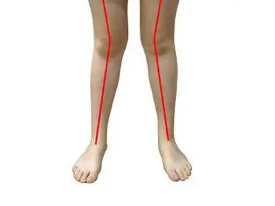 "x"型腿 是怎么回事