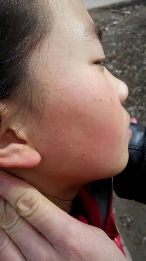 儿童脸部皮肤长痘!