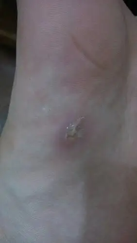 脚底被钉子扎破了,都一个星期过了,变这样了怎么办,消炎药也在吃