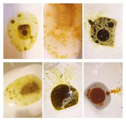 能直接阻断人体对食物中脂肪的吸收,把你吃饭时候吃进去的脂肪以油便