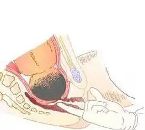 ◤开指=开宫口◢ 医生说的开指其实就是开宫口,又称子宫颈口扩张.