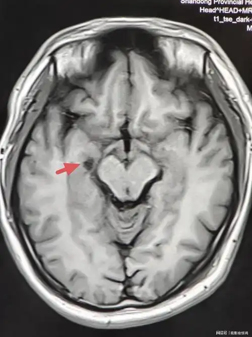 科普脉络膜裂囊肿