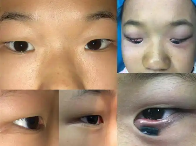 孩子眨眼睛,咋回事?