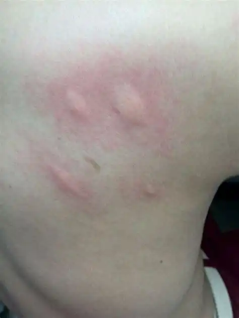 图解各种虫咬症状,各种虫咬后症状图片,各种虫咬图片_大山谷图库