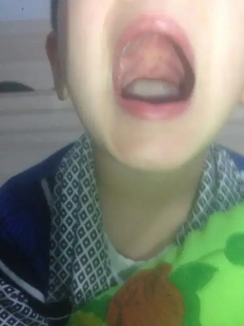 四岁宝宝上膛起了好多小红疙瘩是咋回事