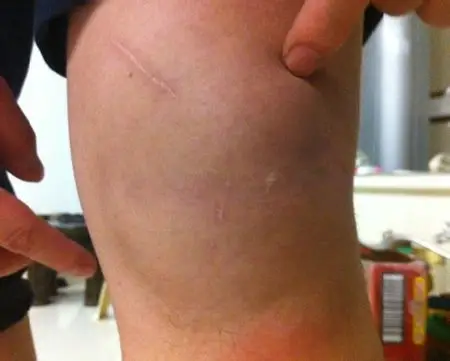 症状         专家详解膝关节肿痛的原因:    1,滑膜炎引起膝盖肿痛