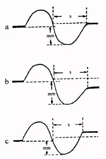 左心房异常(二尖瓣型p波),ptf-v1