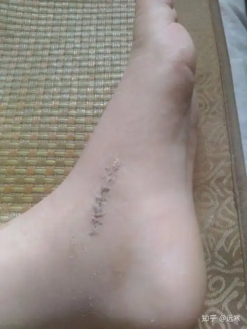 副舟骨手术治疗效果如何?