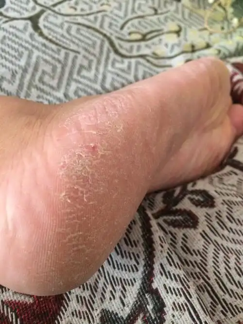 孕期脚后跟很干什么原因,怎么治疗,对胎儿有影响吗