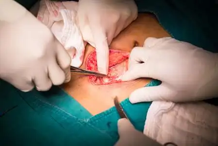 破裂的阑尾炎探讨开腹阑尾切除术照片