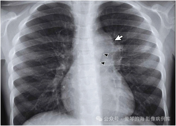 肺结核:活动性,还是非活动性?