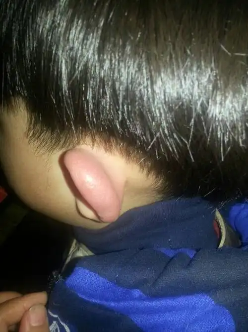 儿子的耳朵肿了,昨天晚上就发现是这样的,不摸不疼,摸就会疼,儿子有