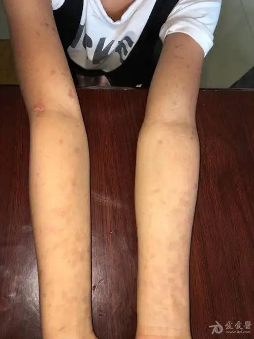 病例讨论手臂散在咖啡色斑