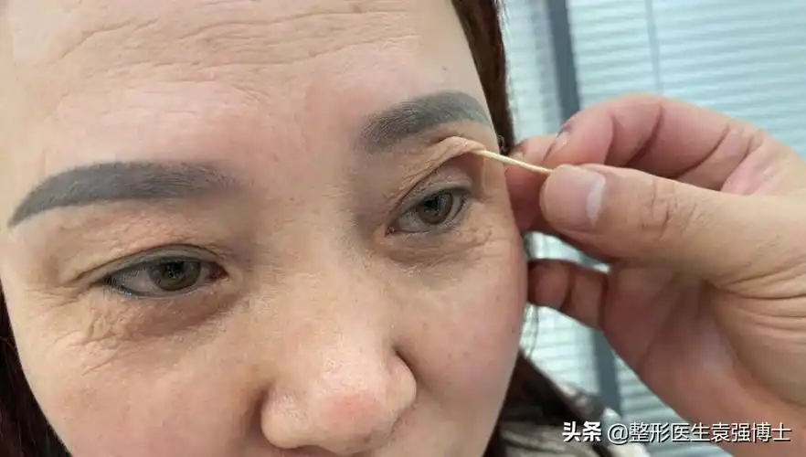 眼皮松弛怎么办 眼皮耷拉,松弛,三角眼,医生说这两种方法还不错