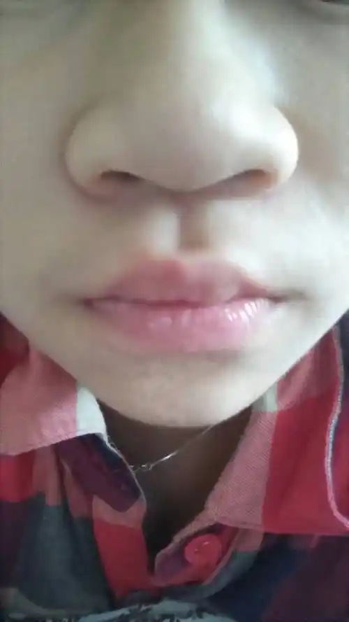 请问这是蒜头鼻吗