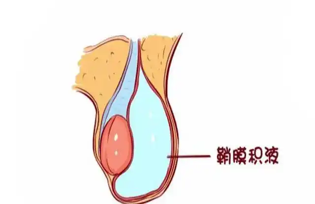 还是带着孩子送去了医院,经过检查后,医生说:孩子是小儿睾丸鞘膜积液