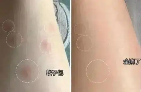 身上被螨虫跳蚤虱子咬了用它也可以止痒▽点击小程序立即购买随身携带