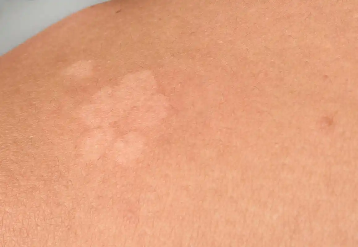 阴茎上长了白斑怎么办	阴茎上长了白斑要根据出现的原因进行针对性