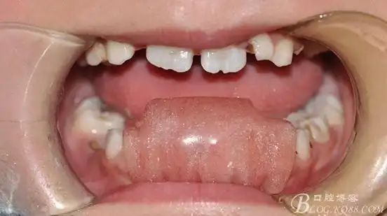 治疗方案:下前牙斜面导板,左下1 加称流体树脂扭转矫正.