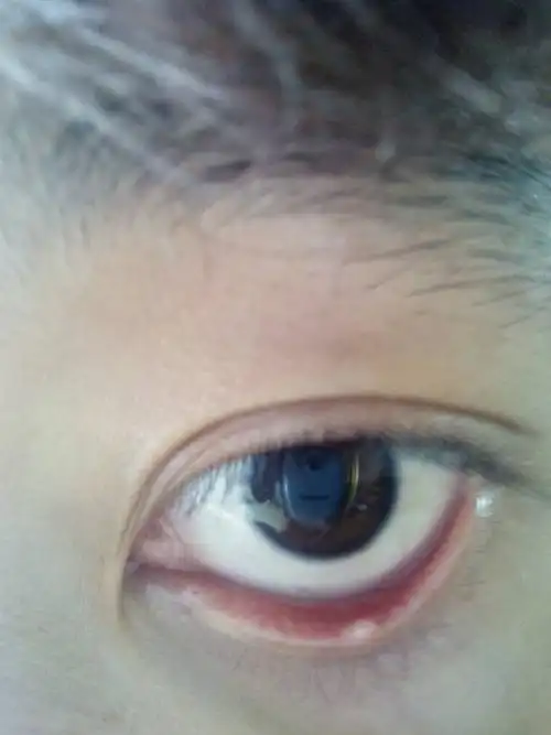 问:眼睛里面突然长出小黄包了怎么办为什么啊?什么时候会好?