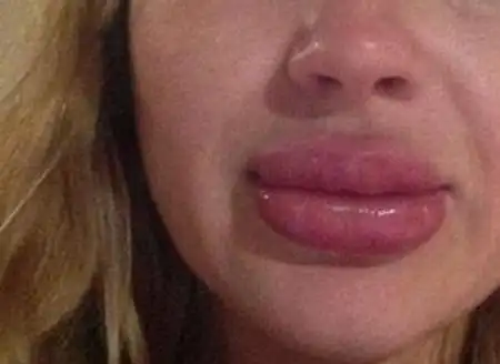 厚嘴唇和香肠嘴的区别所有的厚嘴唇都被称为香肠嘴吗