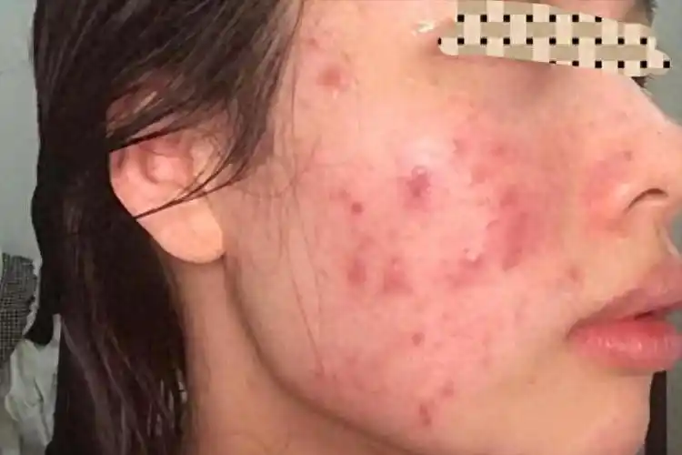 平均每天几毛钱,28天告别红黑痘印_痘痘_皮肤_时候