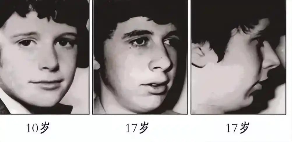 腺样体微创手术过程需要缝多少针,儿童腺样体微创手术费用-友友