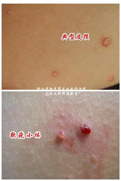 传染性软疣_疾病介绍_治疗方法_传染_ - 好大夫在线