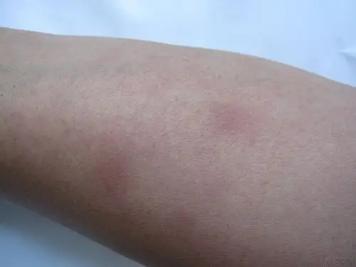 左手小臂外侧肿胀皮肤紫癜样改变