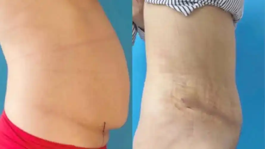 生完宝宝小肚子还在?"腹壁整形"帮宝妈重新找回自信!