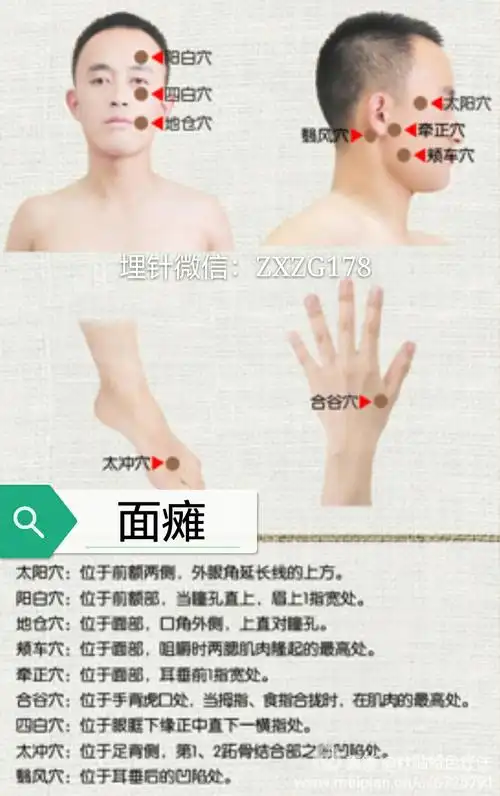 新型针贴面瘫的治疗及穴位详解