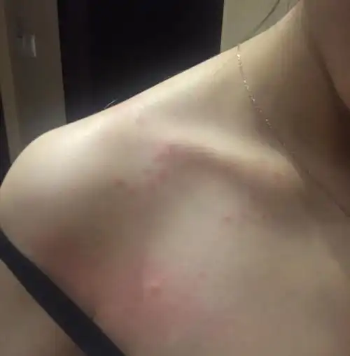 想知道这是过敏还是虫咬的,上半身胸前大胳膊锁骨长了很多很痒?