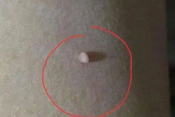 此外,传染性软疣是一种由传染性疣病毒引起的肉疙瘩,中央稍有凹陷,外