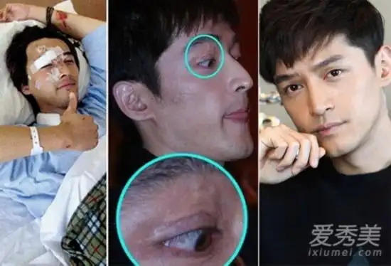 后,容貌变化巨大,特别是右眼出留下惊悚疤痕,经过多次整容修补手术