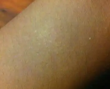 手臂上出现块 一粒粒小的白点 不痛不痒