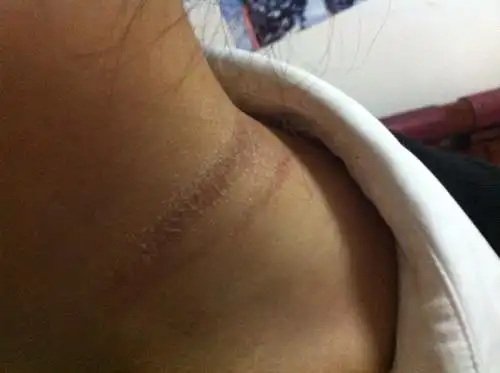 睡了一觉醒来脖子就出现两条这样的勒痕,不
