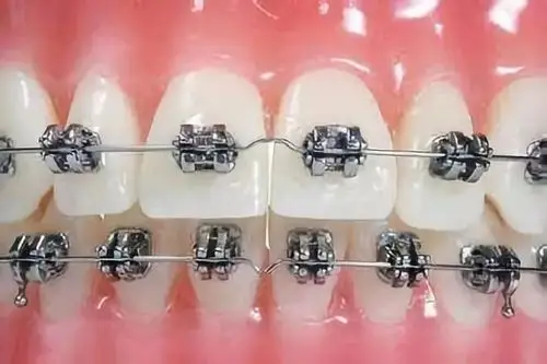 传统金属托槽也就是我们所说的钢丝牙套,如传统金属托槽,陶瓷单晶托槽