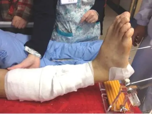 跟骨牵引支架高度调整装置的制作和临床应用