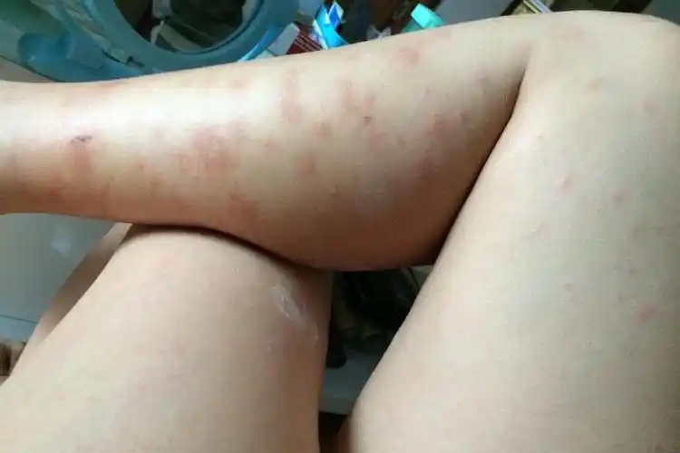 "艾滋病"在出现之前,皮肤会有哪些症状呢?建议了解,不要忽视