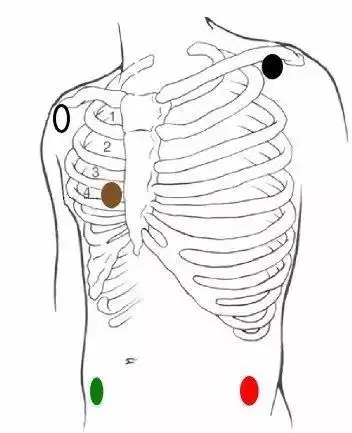 心电监护仪经常用这些问题你能答上来吗