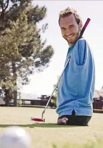 "海豹人"刚出生父亲都呕吐,母亲4个月才敢抱他,现成励志讲师