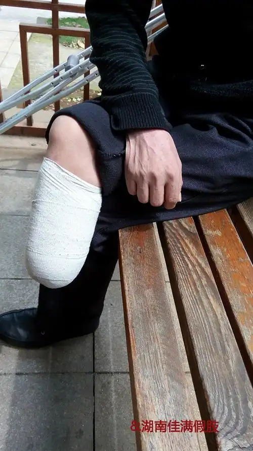 截肢患者的残肢怎么护理湖南佳满假肢
