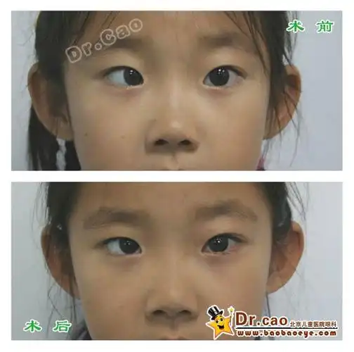 内斜视术前术后1 - 好大夫在线