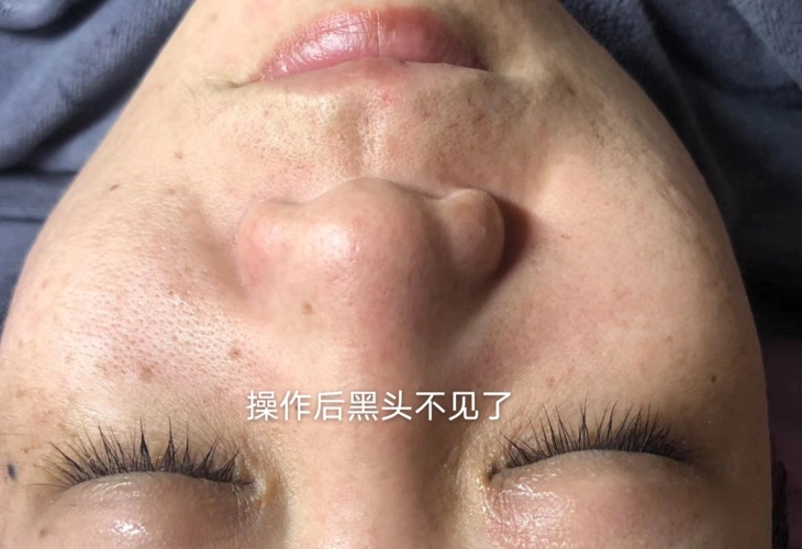 八叶莲华毛囊清洁技术