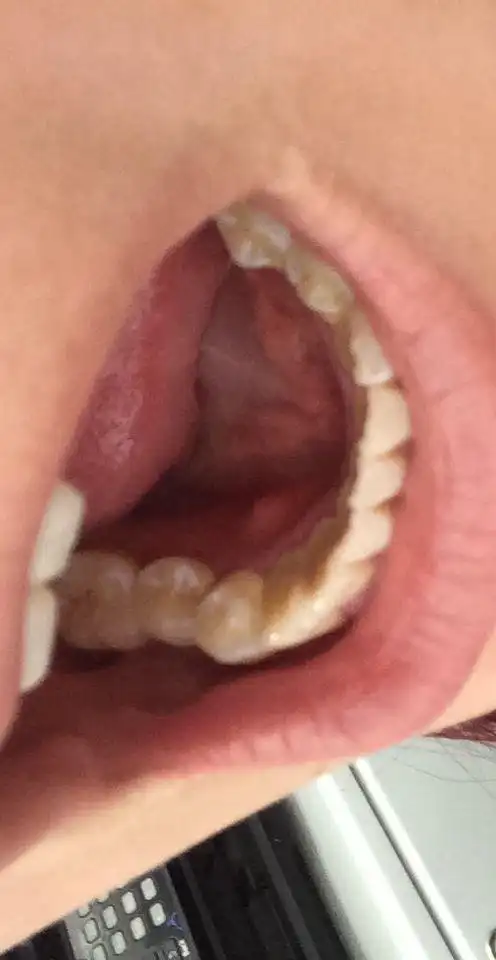 我舌头下面的口腔上长了一个吐出来肉肉的小颗的肉球按上去感觉得